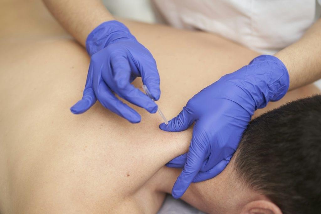 physiotherapist treating an overload with dry needling